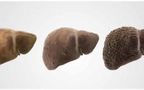 Продолжительность жизни с циррозом печени