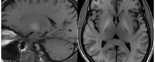 Алкогольная энцефалопатия