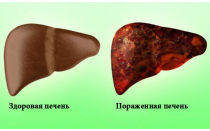 Гепатит токсический