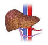 dekompensirovanniy_cirroz