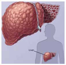 liver_cirroz