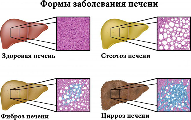 zabolevaniy_pecheni